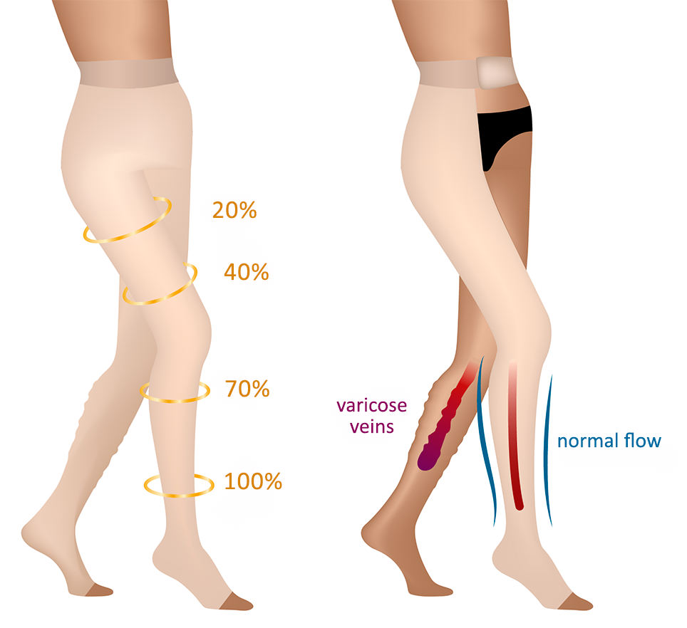 Compression therapy to treat varicose veins in Montreal by Dr Ruz