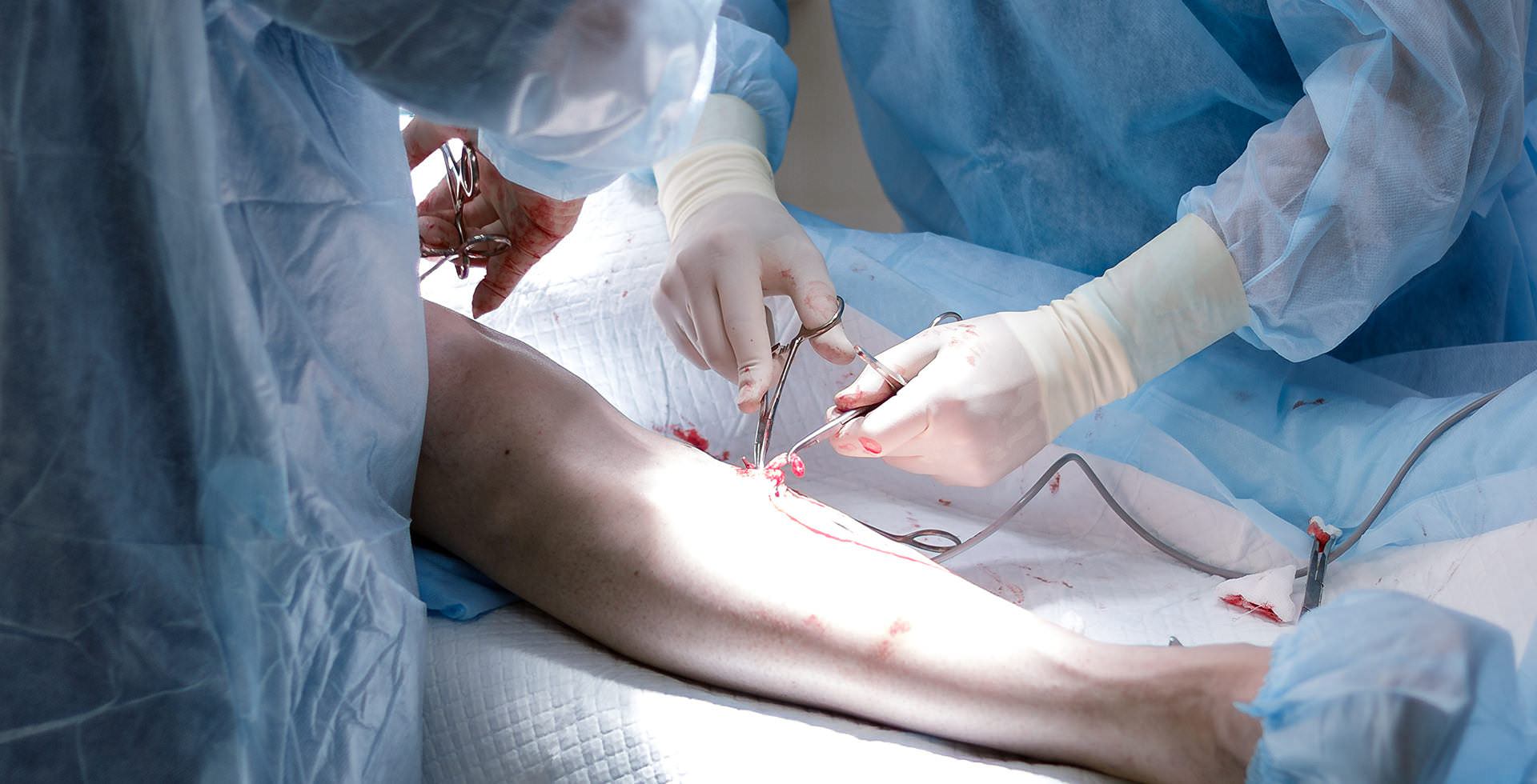 Phlebectomy, venectomy  How to remove varicose veins before