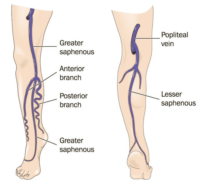 Great and small saphenous veins insufficiency Montreal treatment